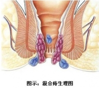 混合痔