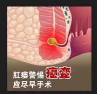 肛瘘