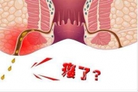 沧州迟大夫治肛瘘