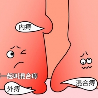 痔疮