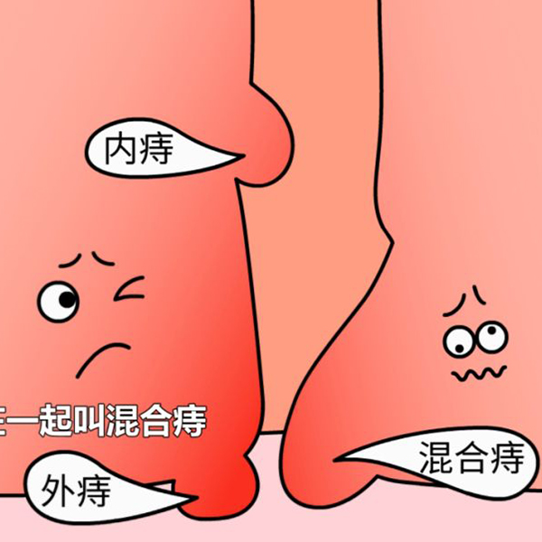 沧州治痔疮 沧州治痔疮